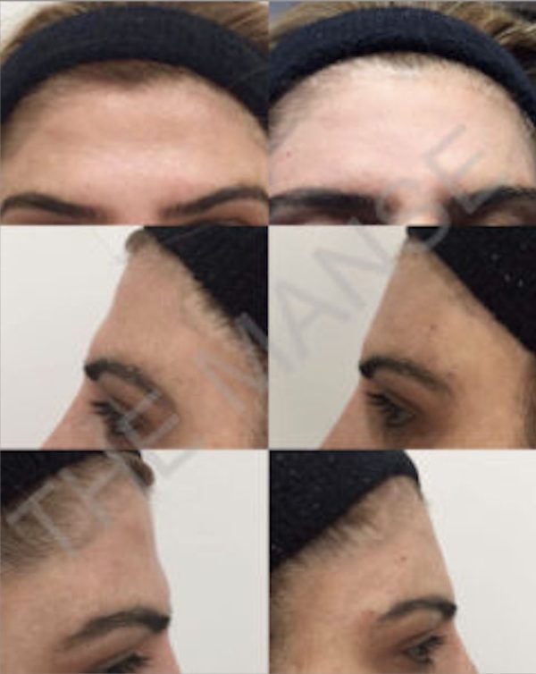 Before and after forehead shape treatment